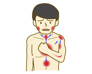 狭心症の胸痛の部位と典型的な放散部位のイラスト